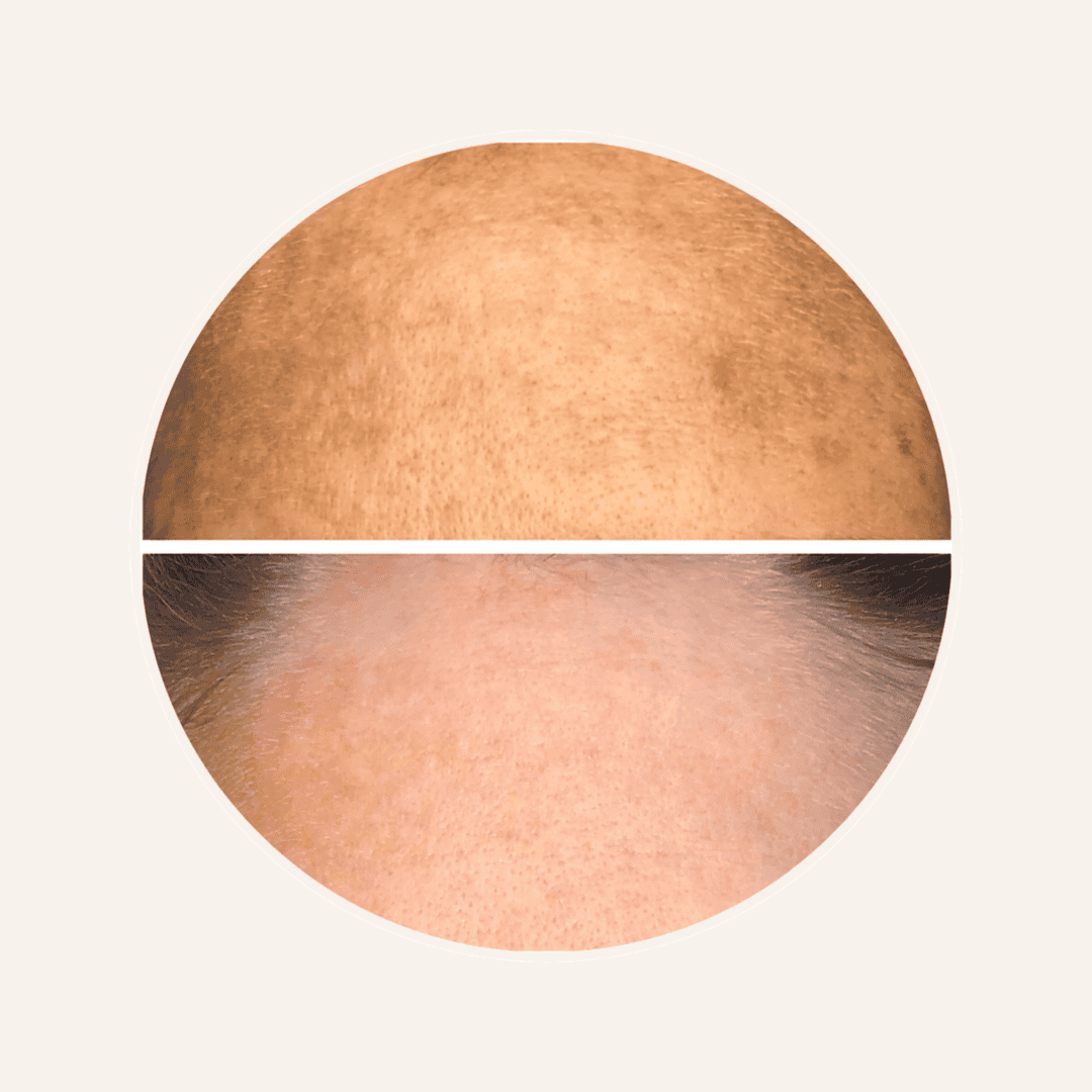 Pigment verminderen Vive huidtherapie Pigment verminderen Vive huidtherapie