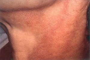Berloque Dermatitis