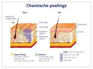 Wat doet een peeling?