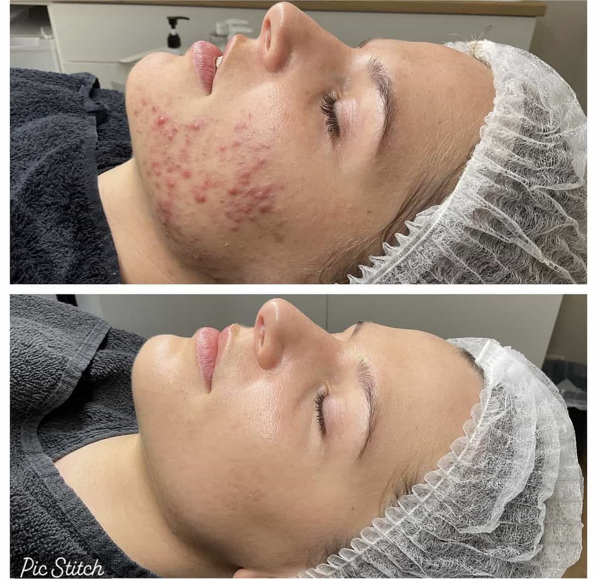 acne behandeling VIVE