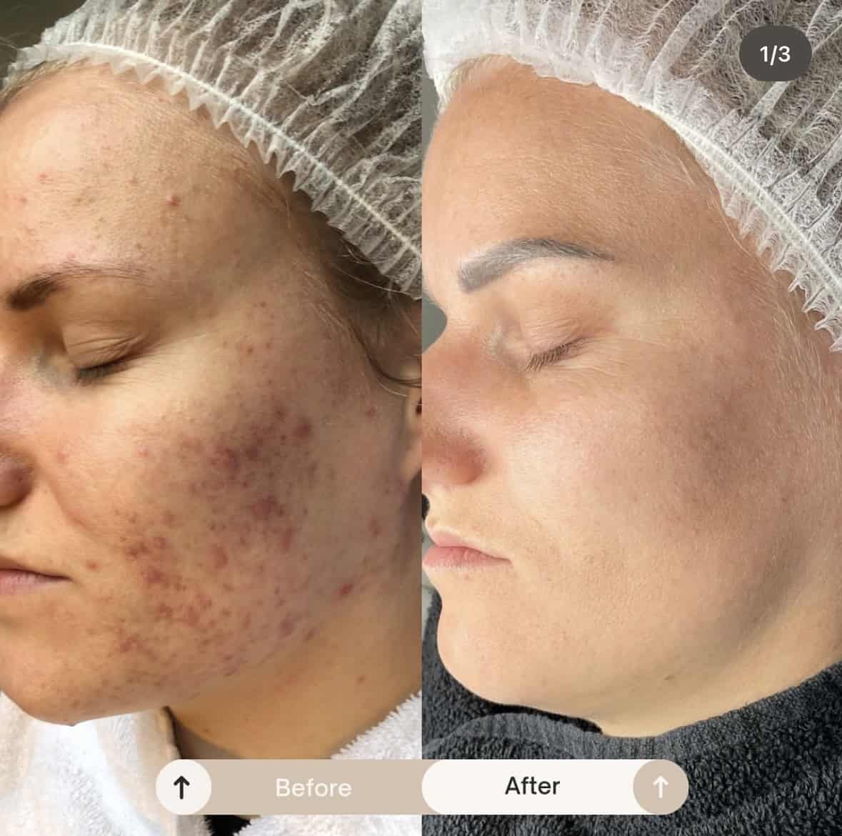 acne behandeling VIVE
