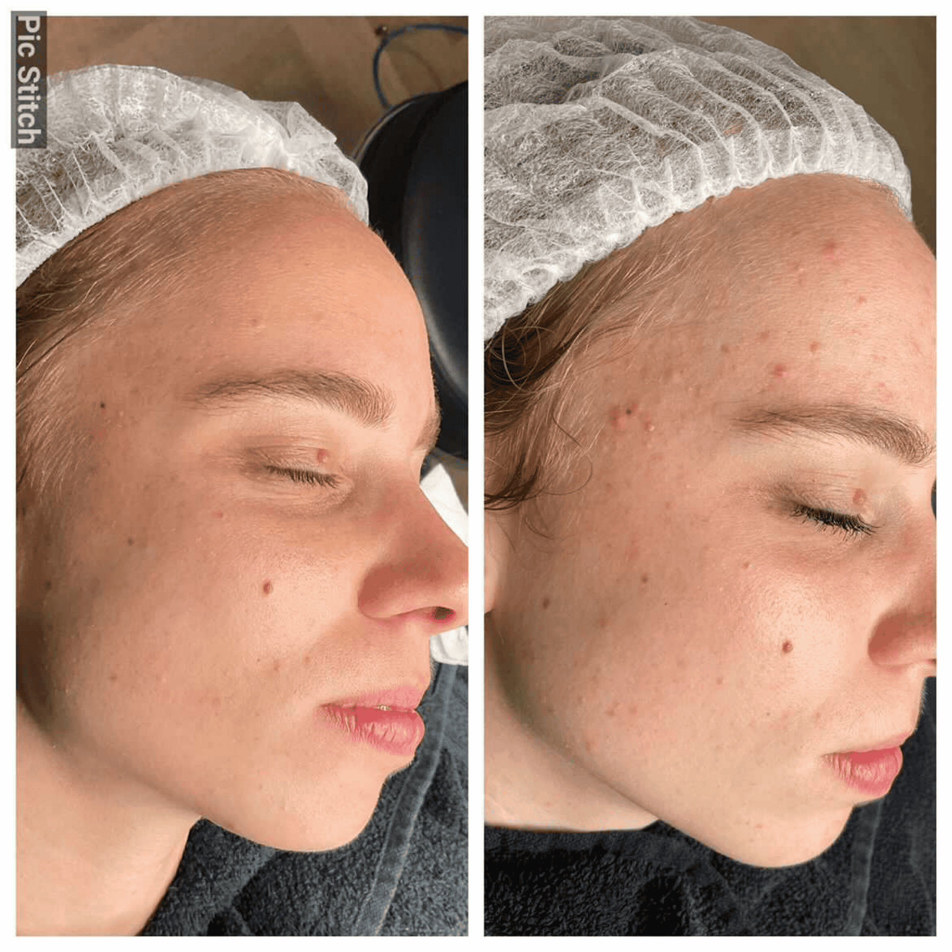 IMG_4052 acne behandeling VIVE