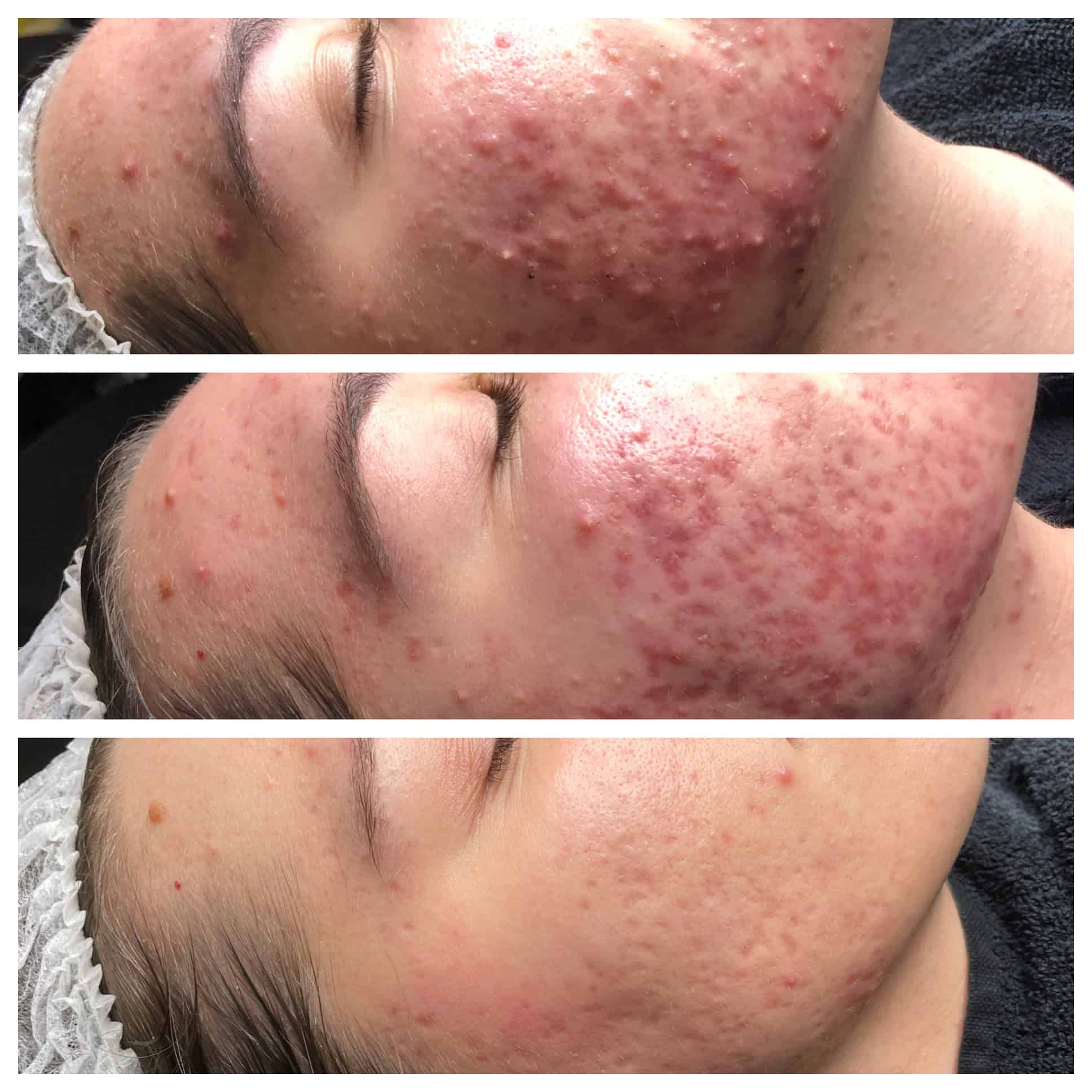 IMG_6155 acne behandeling VIVE