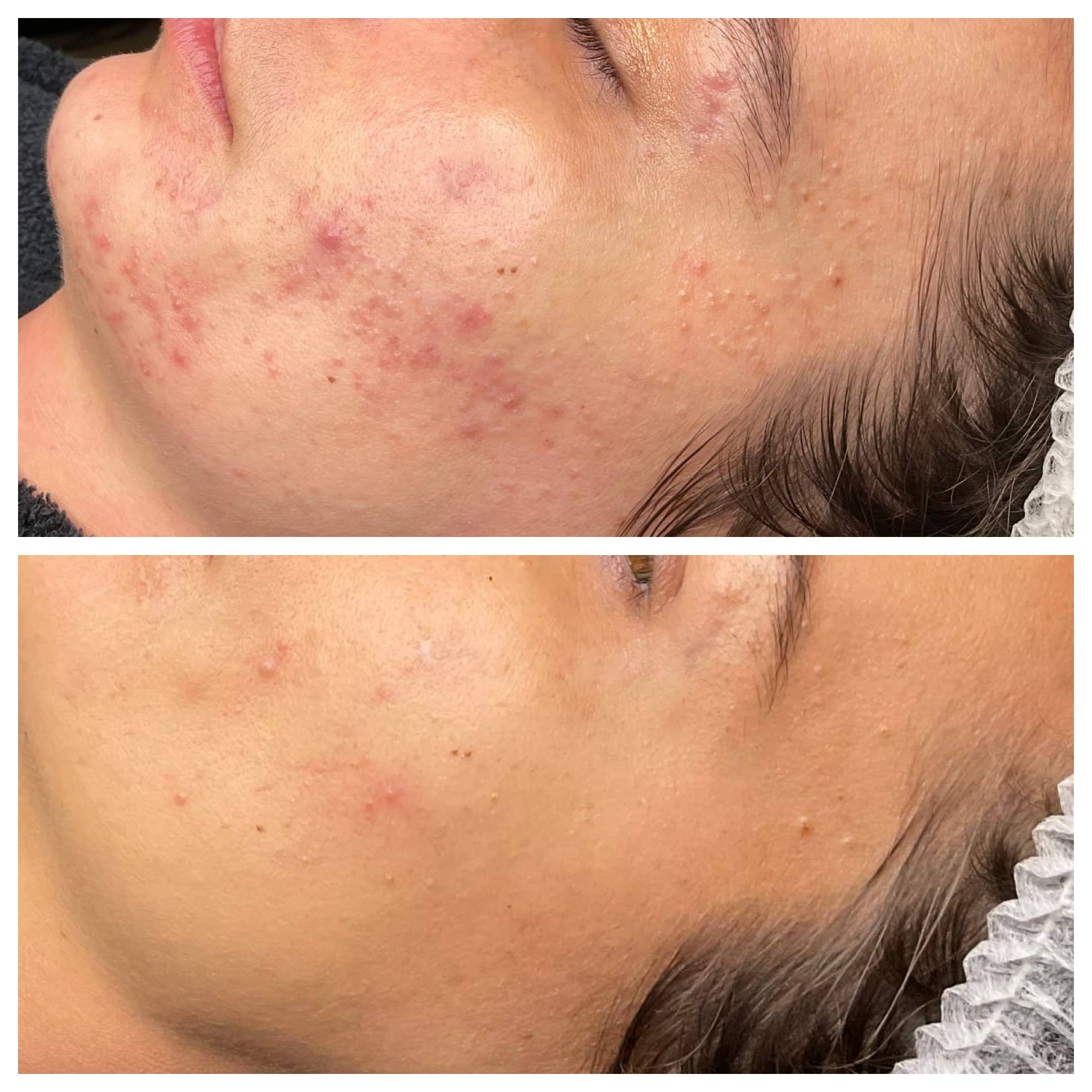 acne behandeling VIVE