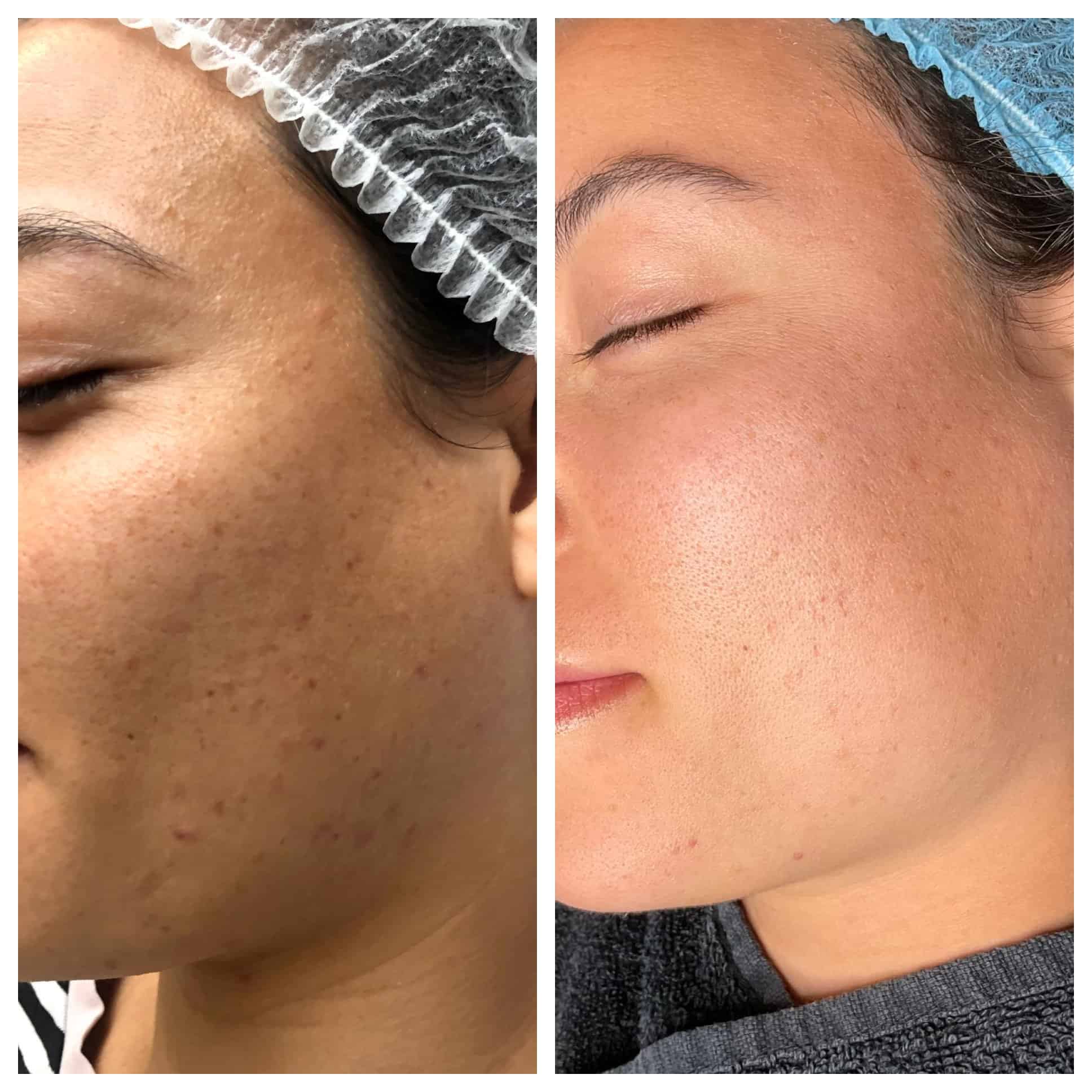 IMG_8034 acne behandeling VIVE
